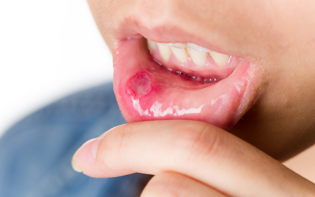 Canker Sores and Iron Deficiency